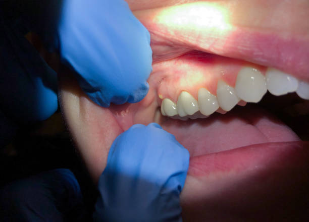 Best Urgent Tooth Repair  in Pierce, NE